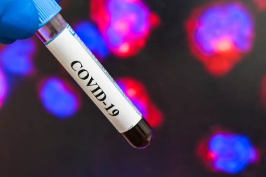 Coronavirus testi. Bir kan örneğinde COVID-19 için antikorların tespiti.