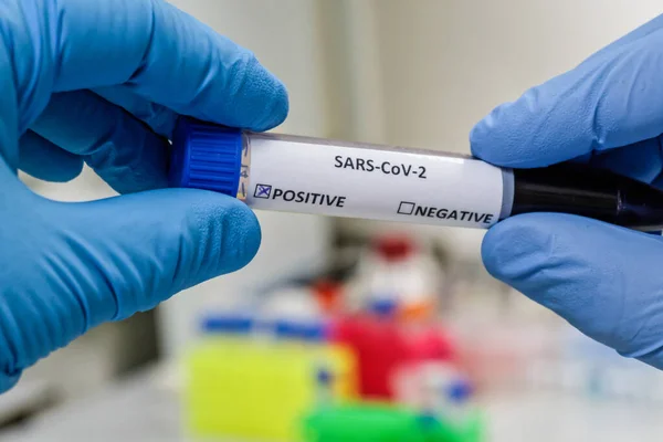 Prueba Del Coronavirus Detección Anticuerpos Para Covid Una Muestra Sangre —  Fotos de Stock