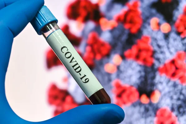 Тест Коронавирус Обнаружение Антител Covid Образце Крови — стоковое фото