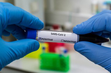 Koronavirüste antikorların tespiti. COVID-19 'dan sonra immünoglobülin testi.