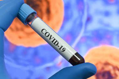 Koronavirüste antikorların tespiti. COVID-19 'dan sonra immünoglobülin testi.