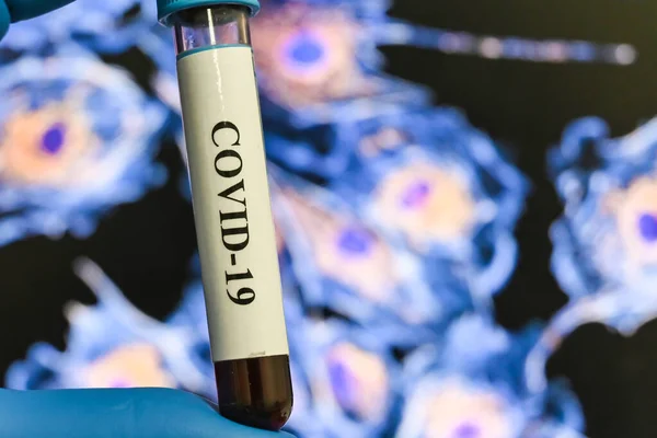 Обнаружение Антител Коронавирусу Тест Иммуноглобулин После Covid — стоковое фото