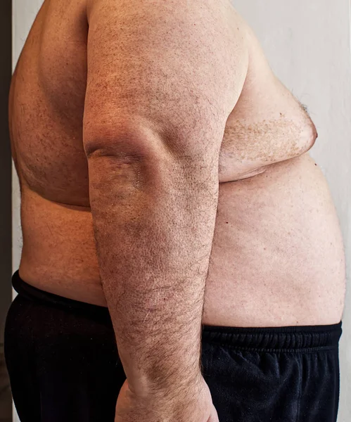 A fat man with a big belly. Obesity, overweight and diet concept