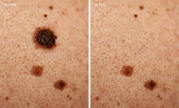 Foto Antes Depois Remoção Toupeira Pele Mulher Conceito Remoção Toupeira — Fotografia de Stock