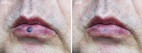 Ağız hizasında venöz gölün kaldırılmasından önce ve sonra..