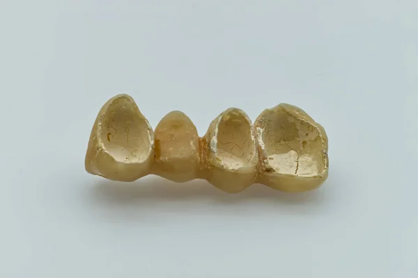 Dentes Resina Temporários Ponte Dentária Provisória Conceito Implante Dentário — Fotografia de Stock