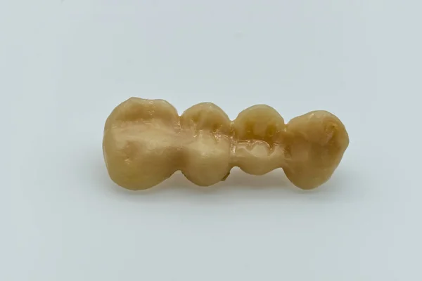 Dentes Resina Temporários Ponte Dentária Provisória Conceito Implante Dentário — Fotografia de Stock