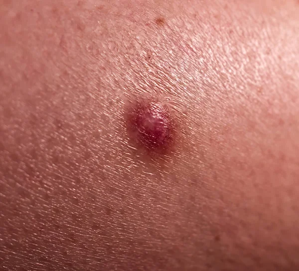 Derinin altında lamba var. İnsan derisinin altında yağ dokusu. Yakın çekim, seçici odaklanma