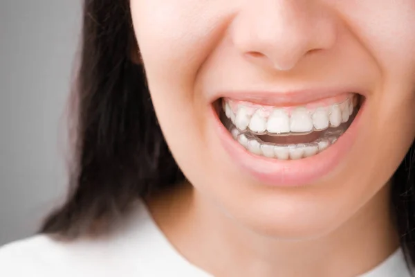 Mulher feliz com um sorriso perfeito em alinhadores transparentes em seus dentes. Aparelhos amovíveis — Fotografia de Stock