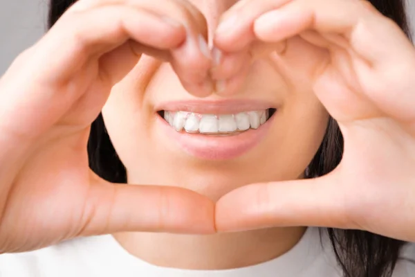 Mulher feliz com um sorriso perfeito em alinhadores transparentes em seus dentes mostra coração com as mãos. Aparelhos amovíveis. — Fotografia de Stock