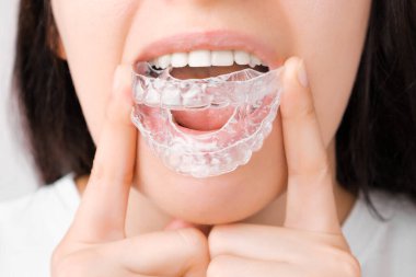 Mükemmel ve sağlıklı dişleri olan gülümseyen kadın çıkarılabilir diş telleri kullanıyor ya da dişleri beyazlatmak ve düzeltmek için hizalanıyor. Isırığın düzeltilmesi için ortodontik tedavi.