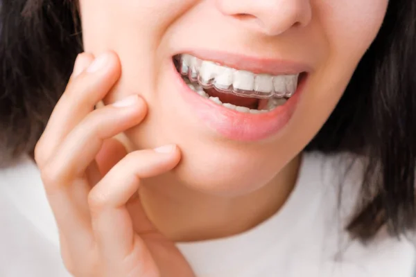 Mujer joven alegre mirando en el espejo en alineadores transparentes para enderezar y blanquear los dientes. Tirantes extraíbles para la corrección de la picadura —  Fotos de Stock