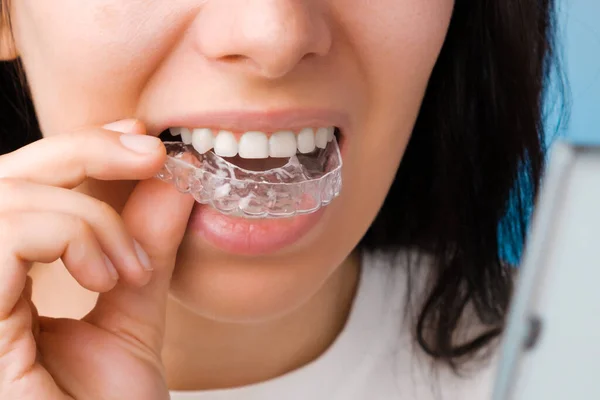 Mulher sorridente com dentes perfeitos e saudáveis usando aparelho removível ou aligner para alisamento e clareamento dos dentes. Tratamento ortodôntico para correção de mordida. — Fotografia de Stock