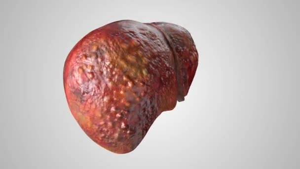 Animação 3d realista de fígado danificado humano estágios doentes de saudável para cirrose hepática — Vídeo de Stock