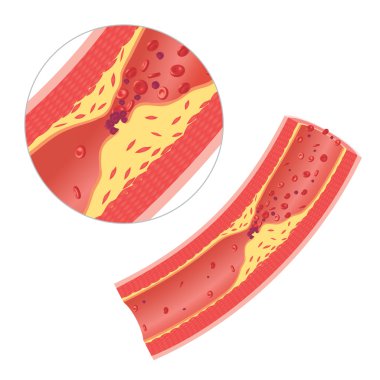Athersclerosis in artery clipart