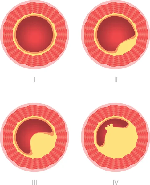 Athersclerosis stages — Stock Vector