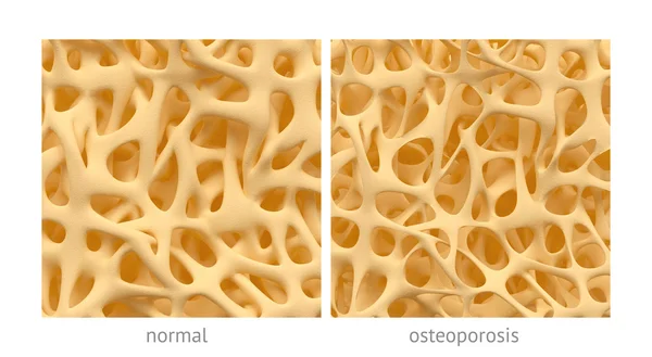 Osteoporosis — Stock Photo, Image