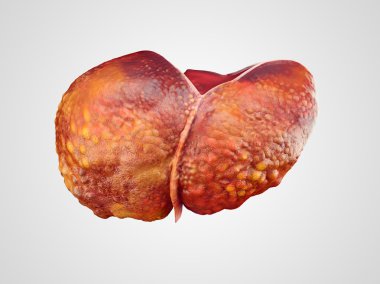 Realistic illustration of cirrhosis of human liver clipart