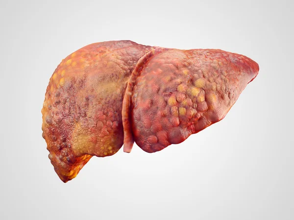 Ilustração realista da cirrose do fígado humano — Fotografia de Stock