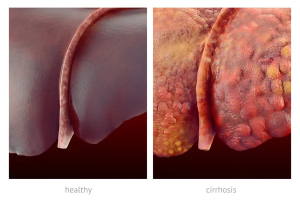 Realistyczne ilustracja zdrowe i chore wątroby ludzkiej — Zdjęcie stockowe