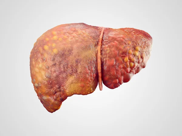 Realistic illustration of cirrhosis of human liver — Stock Photo, Image