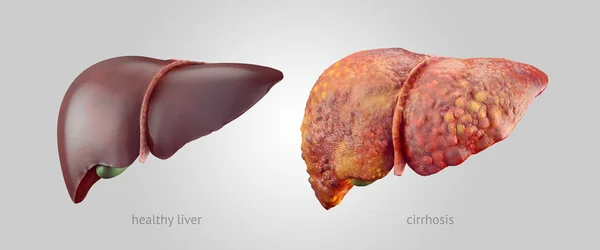 Реалістична ілюстрація здорових і хворих людських печінки — стокове фото