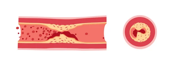 Atherotrombosis in schepen — Stockvector