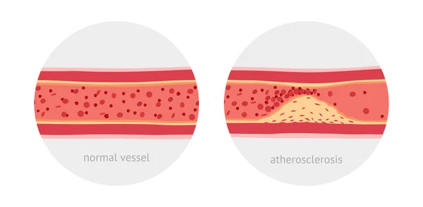 Athérosclérose dans les vaisseaux — Image vectorielle