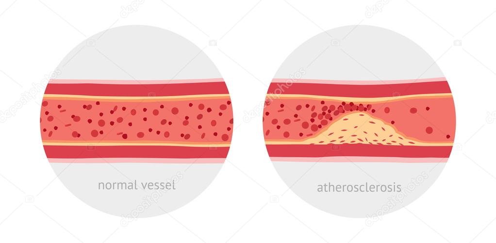 Atherosclerosis In Vessels Vector Image By C Eranicle Vector Stock