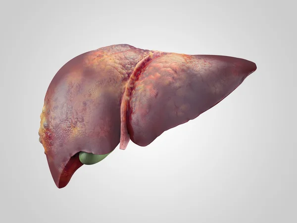 Sick human liver with cancer — Stock Photo, Image