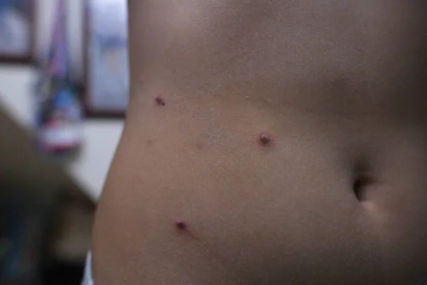 Varicella Virus Chickenpox Bubble Rash Asian Woman Body — Stock Photo, Image