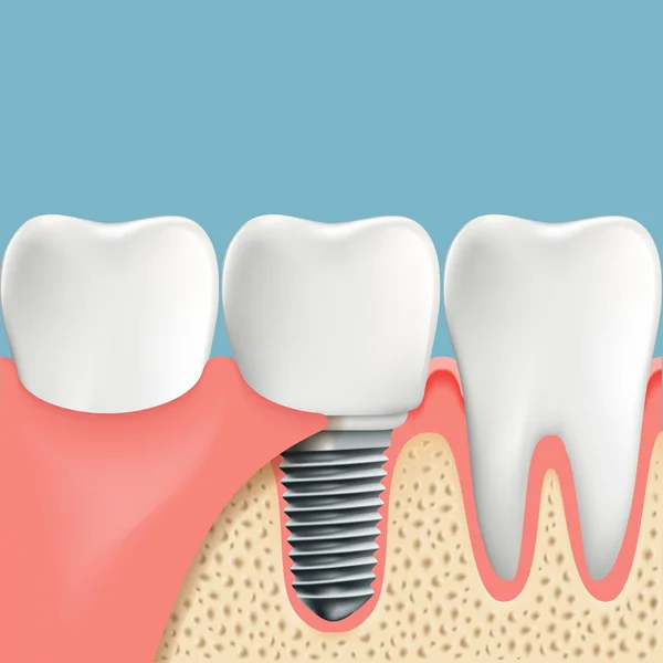 Human teeth and Dental implant — Stock Vector