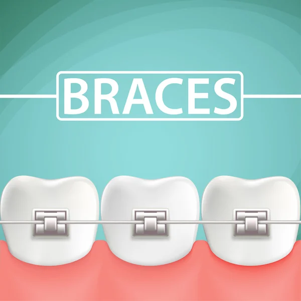 Human teeth with metal braces — Stock Vector