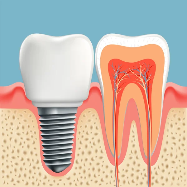 Implante dental y dental humano — Vector de stock