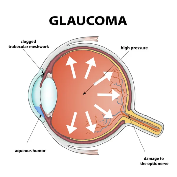 Occhio umano. Malattia glaucoma — Vettoriale Stock