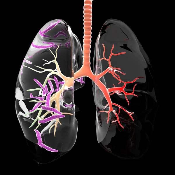 Tuberkulose in der Lunge — Stockfoto