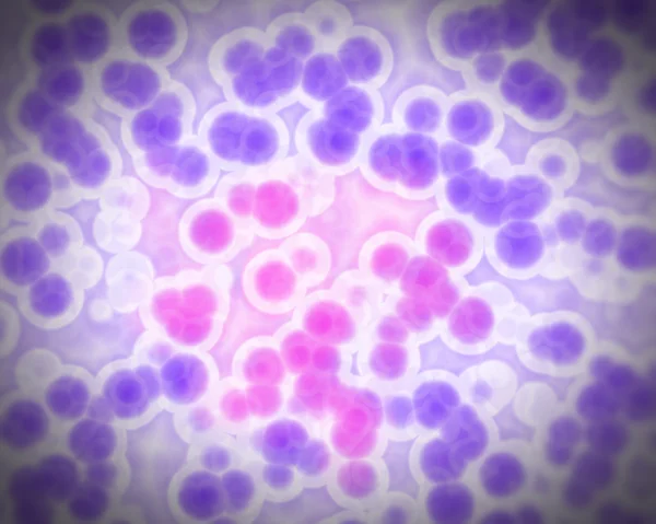 Leukemia cells,Neutrophil , Lymphocyte — Stock Photo, Image