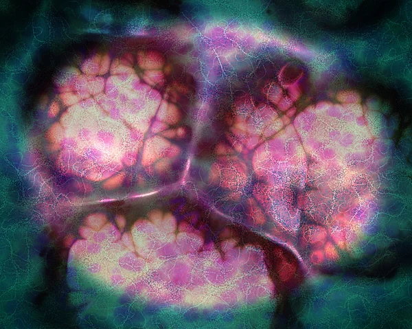 白血病細胞、好中球、リンパ球 — ストック写真