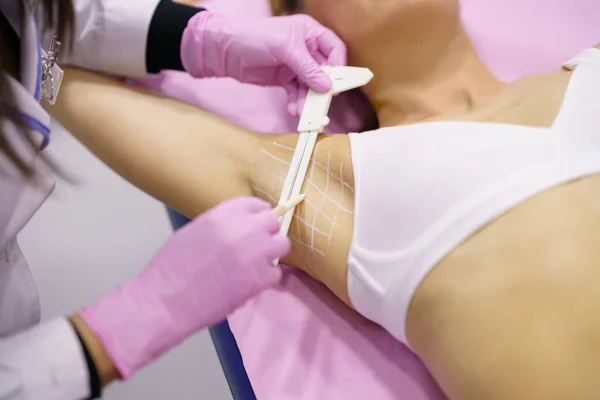 Doctor painting on the armpit of her patient, the area to be treated for hyperhidrosis. — Stock Photo, Image