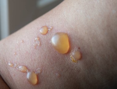 Bir kadının elindeki yanıktan dolayı kabarcıklar. Yakın çekim yanığı. Sıcak sıvıya maruz kalmaktan kaynaklanan termal yanık. Birinci ve ikinci derece termal yanıklar.. 