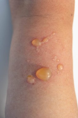 Bir kadının elindeki yanıktan dolayı kabarcıklar. Yakın çekim yanığı. Sıcak sıvıya maruz kalmaktan kaynaklanan termal yanık. Birinci ve ikinci derece termal yanıklar.. 