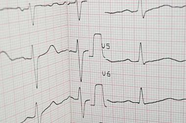 EKG test sonucu