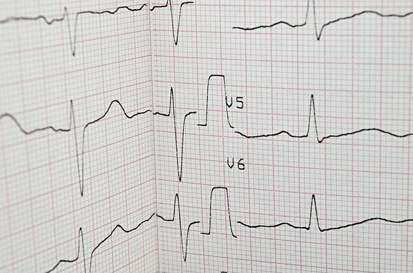 Výsledek testu EKG — Stock fotografie