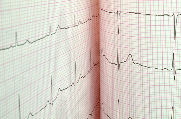 Resultado do ensaio ECG — Fotografia de Stock