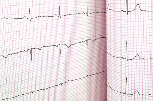 ECG-testresultaat — Stockfoto