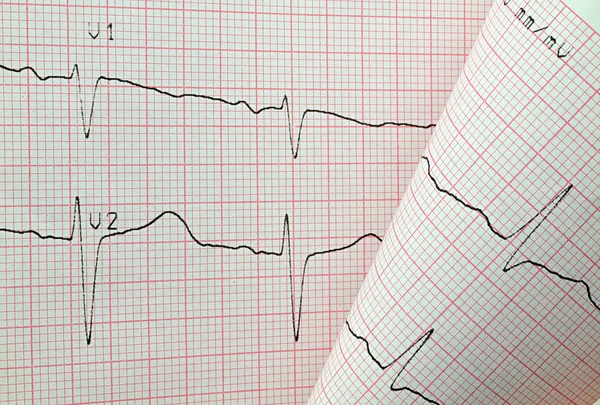 ECG-testresultaat — Stockfoto