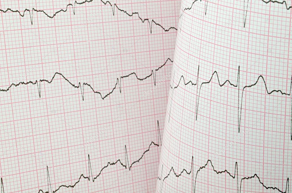 ECG test  result