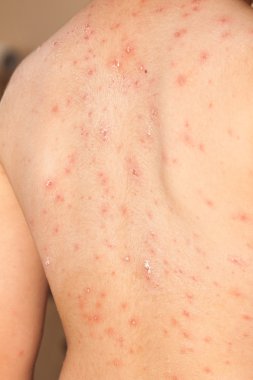 Bebek Tavuk Pox'u döküntü ile detay