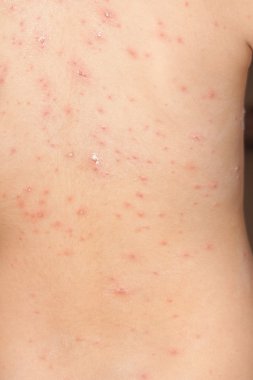 Bebek Tavuk Pox'u döküntü ile detay