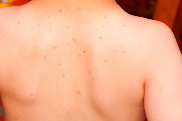Detail baby with chicken pox rash — Stock Photo, Image